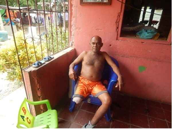 Man missing leg sitting outside